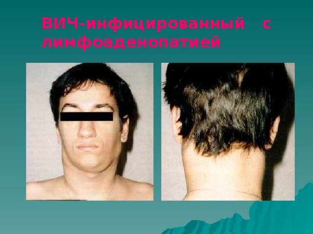 ВИЧ-инфицированный с лимфоаденопатией