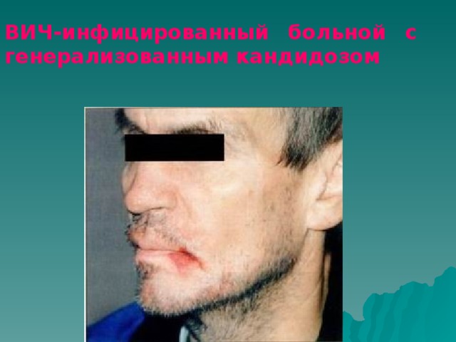 ВИЧ-инфицированный больной с генерализованным кандидозом