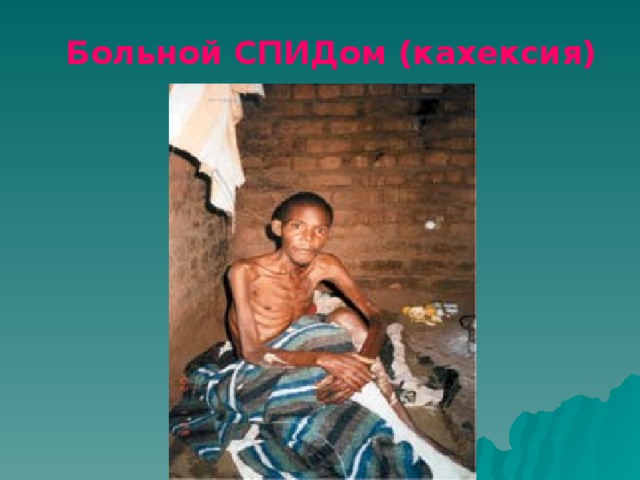 Больной СПИДом (кахексия)