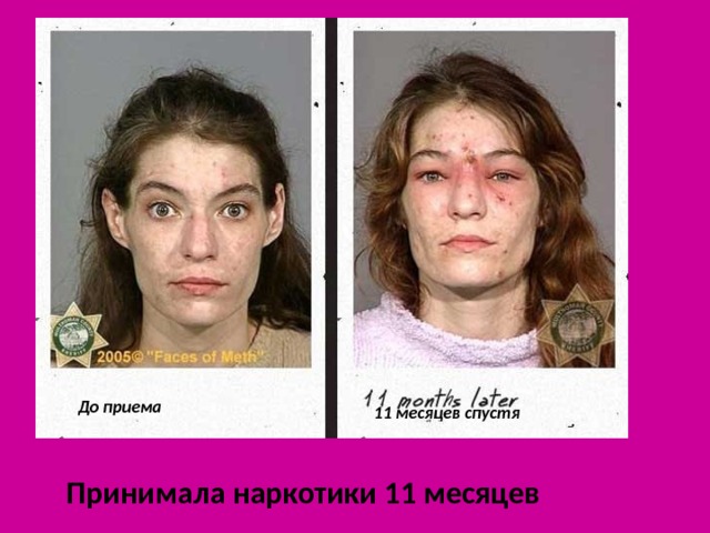 До приема 11 месяцев спустя Принимала наркотики 11 месяцев 