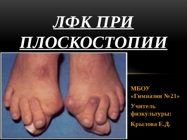 ЛФК ПРИ ПЛОСКОСТОПИИ МБОУ «Гимназия №21» Учитель физкультуры: Крылова Е.Д. 