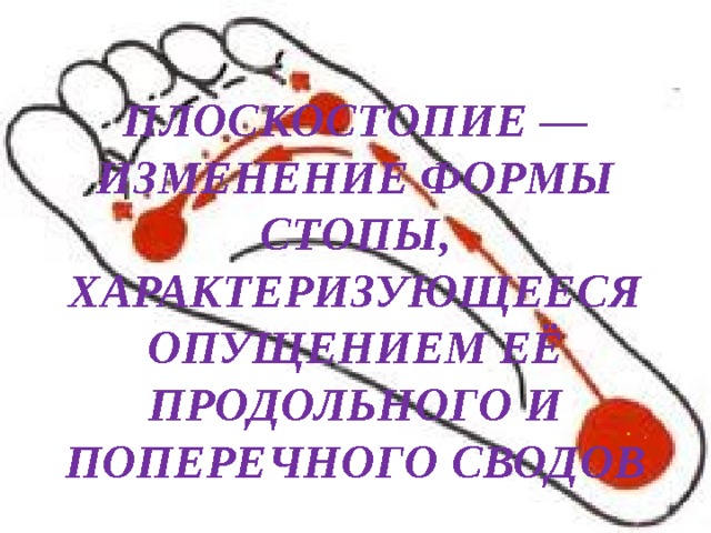 Плоскостопие — изменение формы стопы, характеризующееся опущением её продольного и поперечного сводов . 