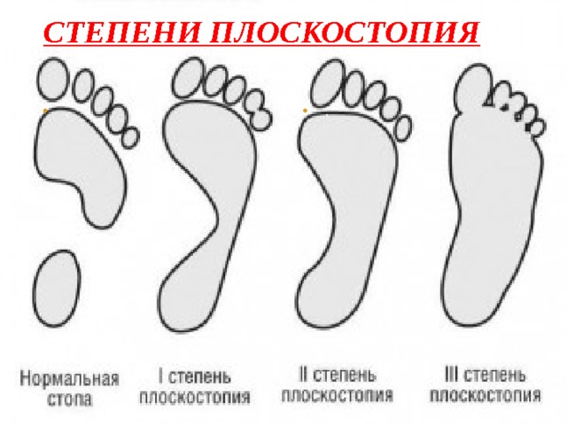 Степени плоскостопия . . 