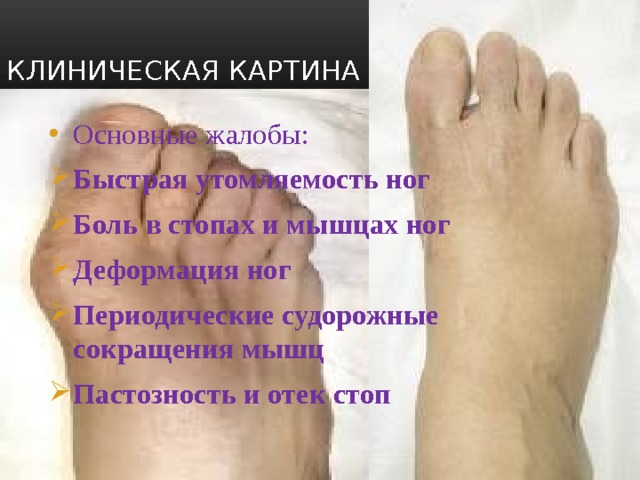 Клиническая картина Основные жалобы: Быстрая утомляемость ног Боль в стопах и мышцах ног Деформация ног Периодические судорожные сокращения мышц Пастозность и отек стоп 
