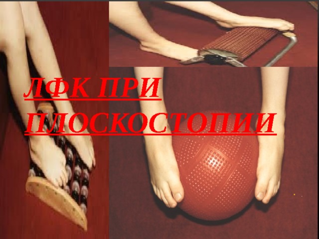 ЛФК ПРИ ПЛОСКОСТОПИИ . 