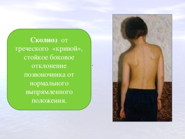 Сколиоз от греческого «кривой», стойкое боковое отклонение позвоночника от нормального выпрямленного положения. . . 