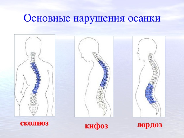 Основные нарушения осанки  сколиоз лордоз кифоз 