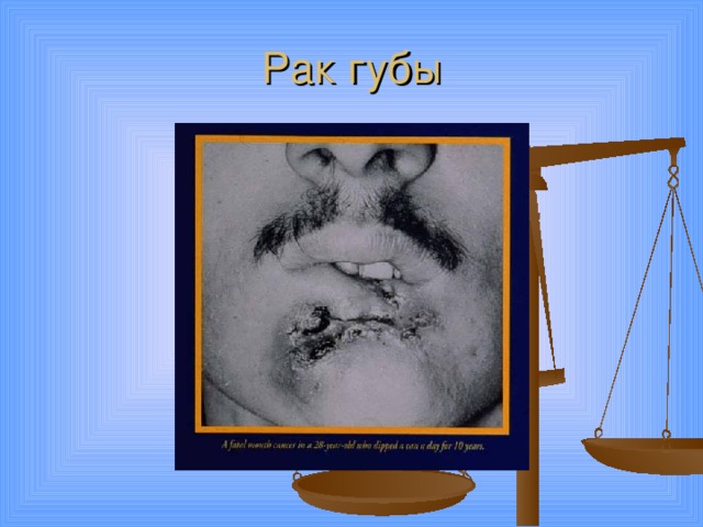 Рак губы 