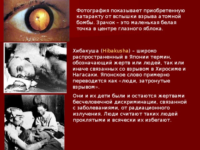 Фотография показывает приобретенную катаракту от вспышки взрыва атомной бомбы. Зрачок – это маленькая белая точка в центре глазного яблока.    Хибакуша ( Hibakusha ) – широко распространенный в Японии термин, обозначающий жертв или людей, так или иначе связанных со взрывом в Хиросиме и Нагасаки. Японское слово примерно переводится как «люди, затронутые взрывом».    Они и их дети были и остаются жертвами бесчеловечной дискриминации, связанной с заболеваниями, от радиационного излучения. Люди считают таких людей проклятыми и всячески их избегают.      