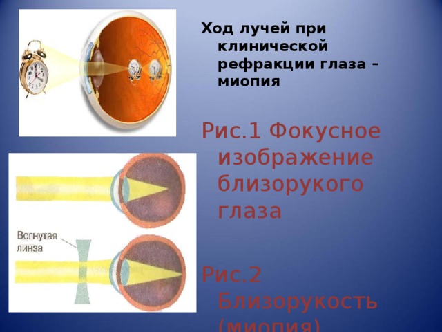 Ход лучей при клинической рефракции глаза – миопия  Рис.1 Фокусное изображение близорукого глаза Рис.2 Близорукость (миопия) 