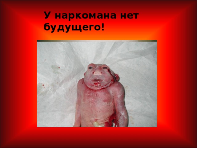 У наркомана нет будущего!