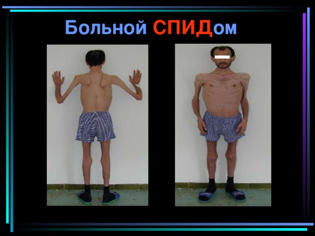 Больной СПИД ом 