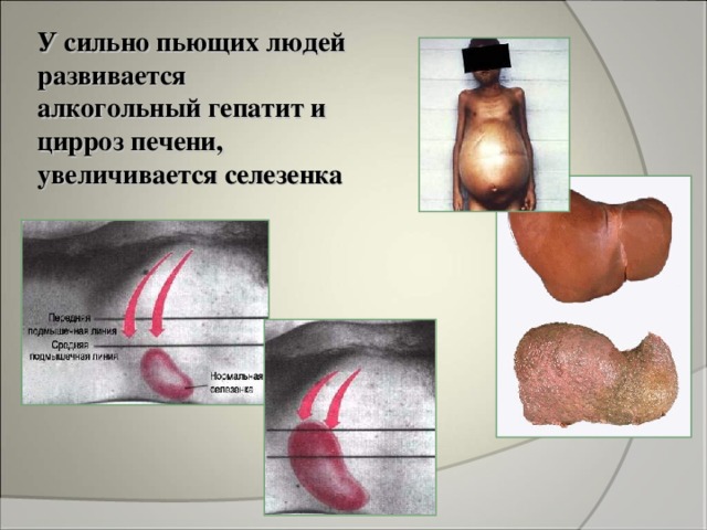 У сильно пьющих людей развивается алкогольный гепатит и цирроз печени, увеличивается селезенка 