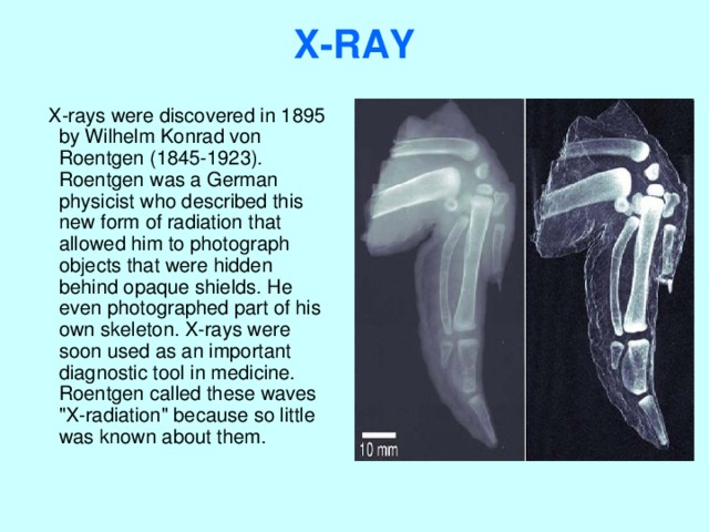 X-RAY    X-rays were discovered in 1895 by Wilhelm Konrad von Roentgen (1845-1923). Roentgen was a German physicist who described this new form of radiation that allowed him to photograph objects that were hidden behind opaque shields. He even photographed part of his own skeleton. X-rays were soon used as an important diagnostic tool in medicine. Roentgen called these waves 