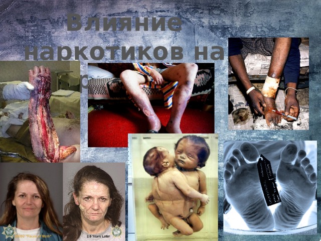 Влияние наркотиков на организм 