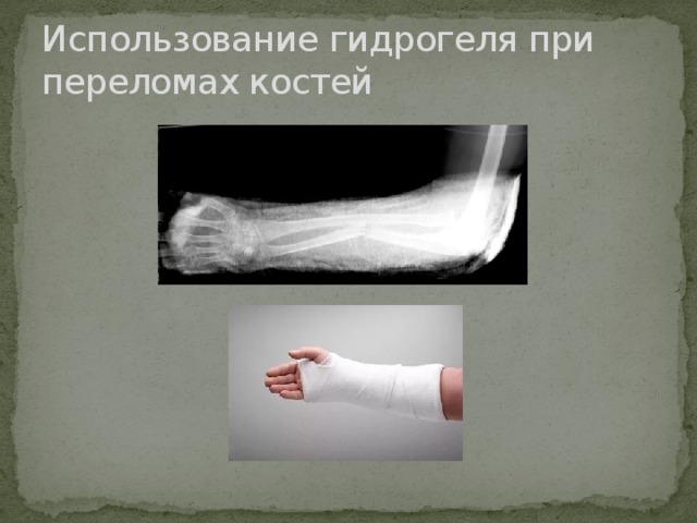 Использование гидрогеля при переломах костей 