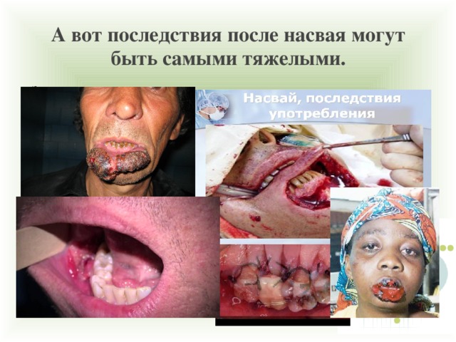 А вот последствия после насвая могут быть самыми тяжелыми. 