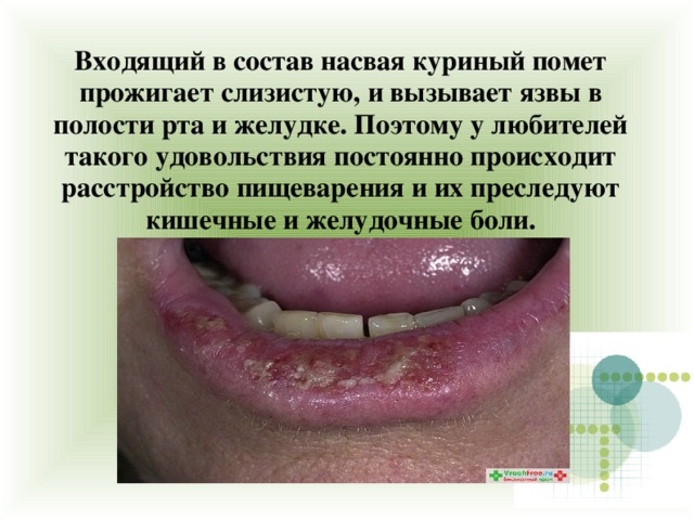 Входящий в состав насвая куриный помет прожигает слизистую, и вызывает язвы в полости рта и желудке. Поэтому у любителей такого удовольствия постоянно происходит расстройство пищеварения и их преследуют кишечные и желудочные боли.  