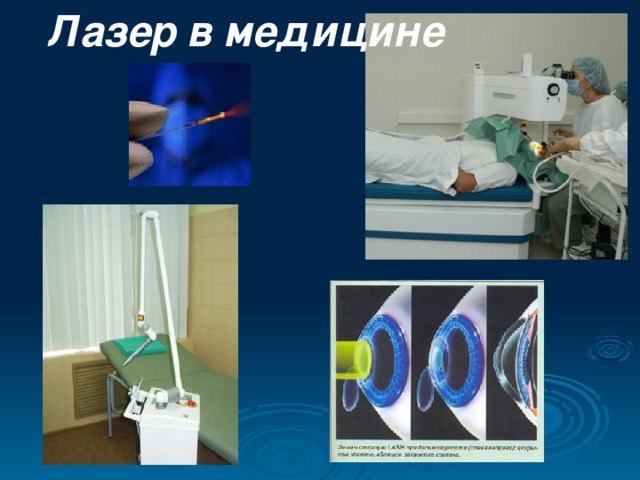 Лазер  в  медицине