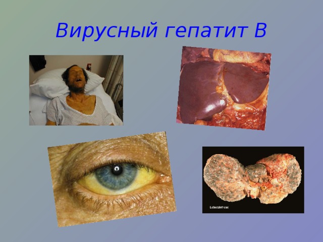 Вирусный гепатит В 
