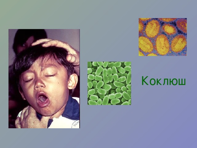 Коклюш 