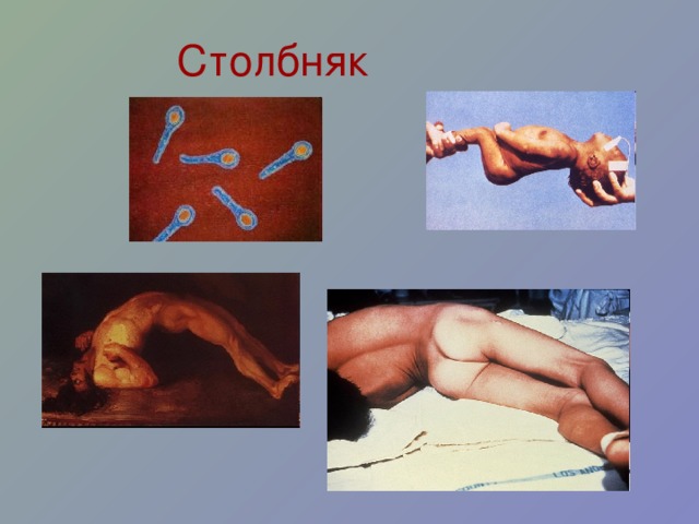 Столбняк 