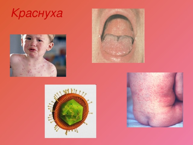 Краснуха 