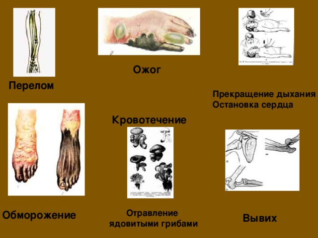 Ожог Перелом Прекращение дыхания Остановка сердца Кровотечение  Отравление ядовитыми грибами Обморожение Вывих 