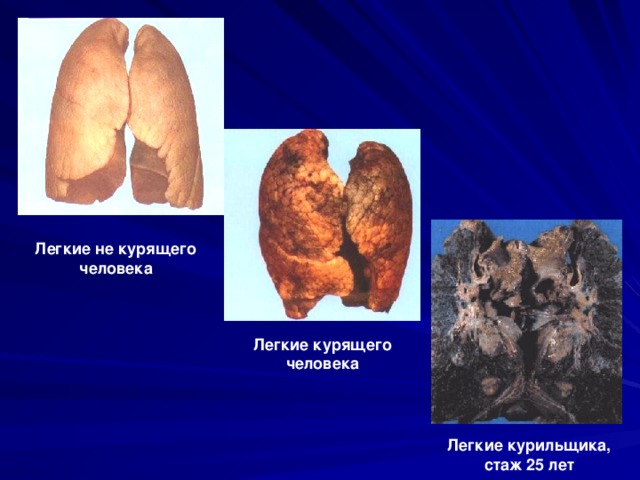Легкие не курящего человека Легкие курящего человека Легкие курильщика, стаж 25 лет 