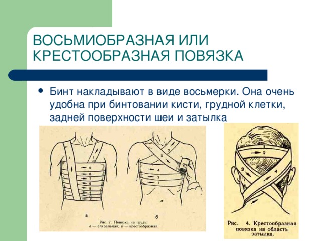 ВОСЬМИОБРАЗНАЯ ИЛИ КРЕСТООБРАЗНАЯ ПОВЯЗКА  Бинт накладывают в виде восьмерки. Она очень удобна при бинтовании кисти, грудной клетки, задней поверхности шеи и затылка 