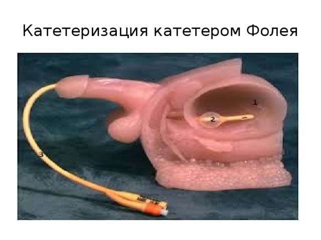 Катетеризация катетером Фолея 