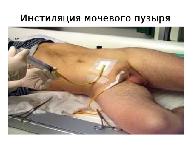 Инстиляция мочевого пузыря 